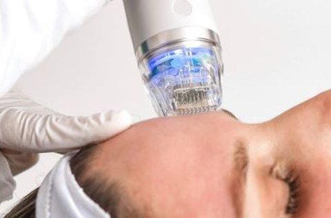 Frakcionált Microneedle RF arcfiatalítás