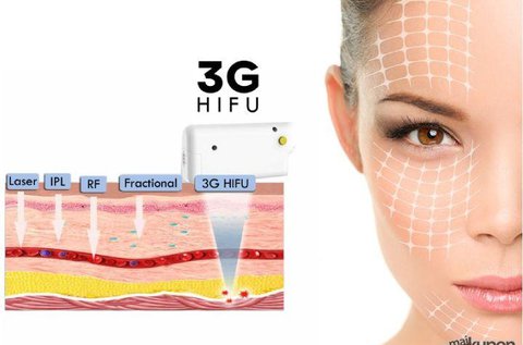 3G HIFU  fiatalító teljes arckezelés