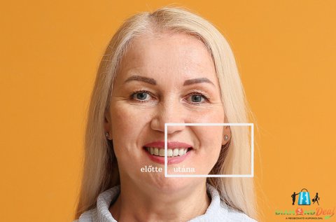 Ultrahangos fogkő-eltávolítás