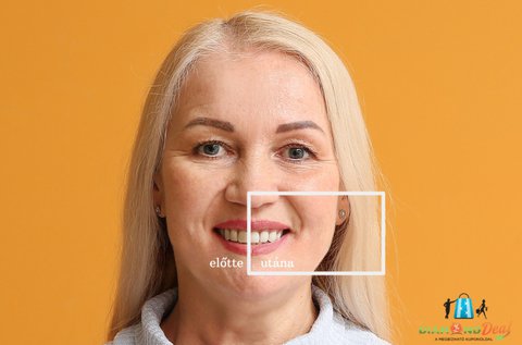 Ultrahangos fogkő-eltávolítás