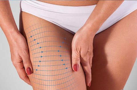 3 alkalmas zsírbontó és vízhajtó kezelés combról