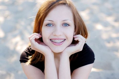 Fém fogszabályozó készülék 1 fogívre