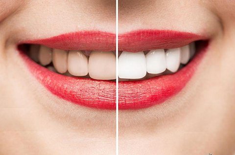 Peroxidmentes fogfehérítés polírozással