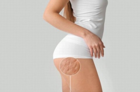 4 alkalmas alakformálás a makacs zsírpárnák ellen