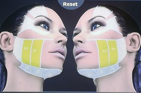 Professzionális HIFU ránctalanítás teljes arcon