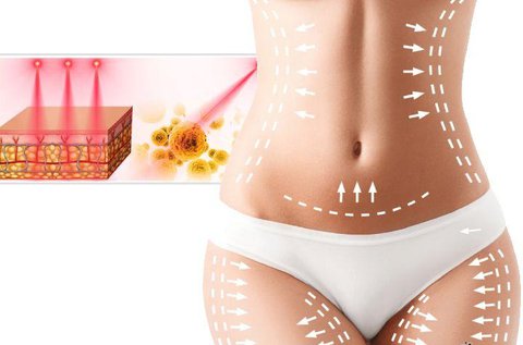 4 alkalmas zsírbontó kezelés  lipolézerrel