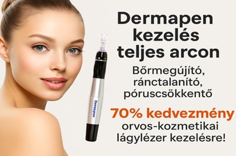 Dermapen kezelés 4D hyaluronsavakkal
