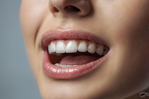 Ultrahangos fogkő-eltávolítás