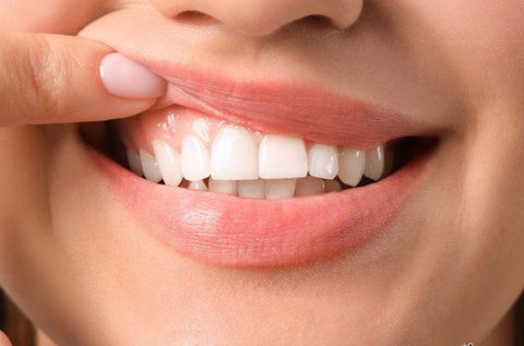 Lézeres fogínysorvadás kezelés