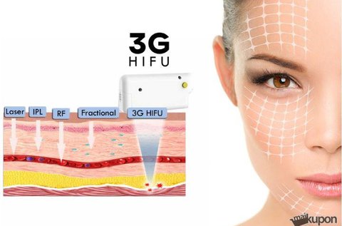3G HIFU mikrofókuszált ultrahangos arcfiatalítás