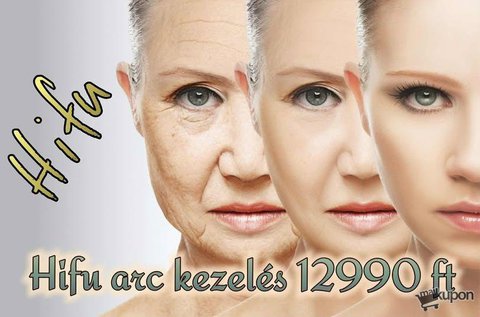 HIFU nagy intenzitású ultrahangos bőrfiatalítás