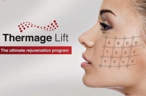 Thermage IV. mátrixpontos RF ránckezelés arcon
